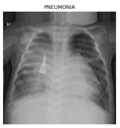 Xray_Pneumonia